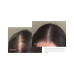 Minoxidil Topical Aerosol 5%, 2.11 oz.
